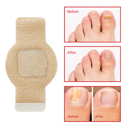 Onychomycosis stickers